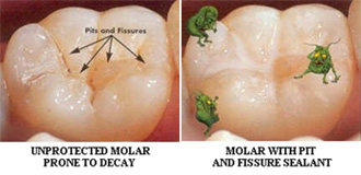 image of dental sealant